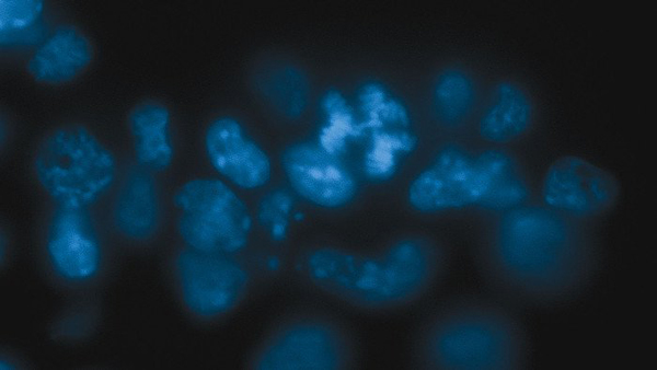 Найден способ стабилизировать хромосомы при раковых заболеваниях