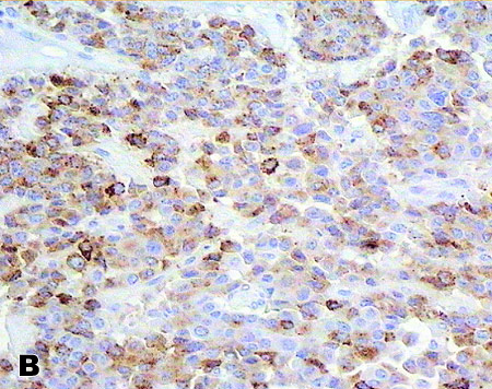 Высокодифференцированные нейроэндокринные опухоли желудка 1 типа (низкой степени злокачественности) с метастазами в лимфатических узлах