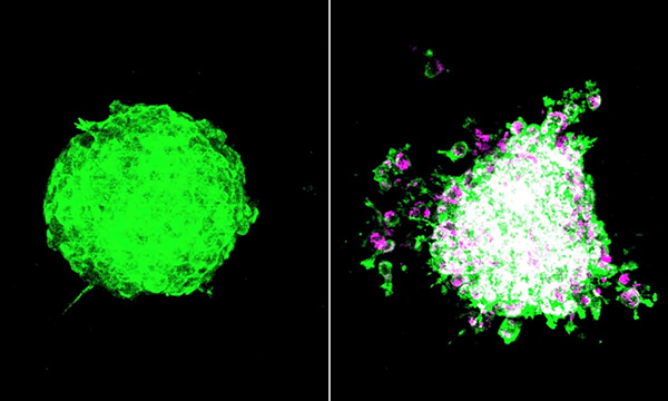Ученые показали, как бактерии помогают опухоли преодолевать иммунную защиту и метастазировать