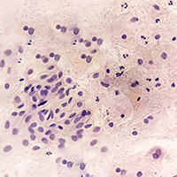 Световая нанотехнология обеспечит точное и менее вредное лечение рака