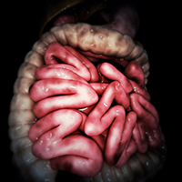 Рак кишки с метастазами операцию не принял