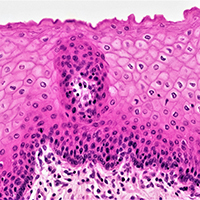 Операция при 0 стадии рака как альтернатива