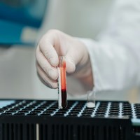 Анализ на ПСА до рака не будет бесполезным после развития рака